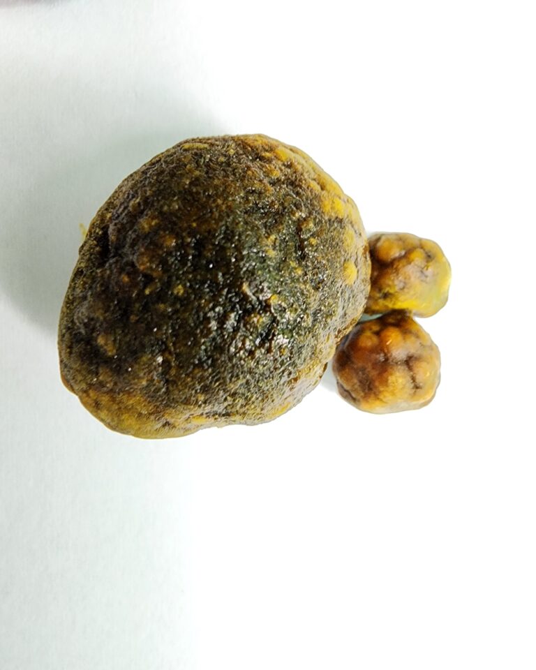 담낭 담석 결석 수술