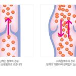 하지정맥류 발생원인 혈류