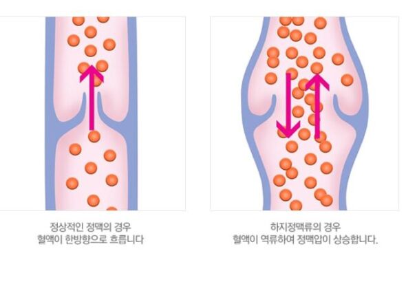 하지정맥류 발생원인 혈류