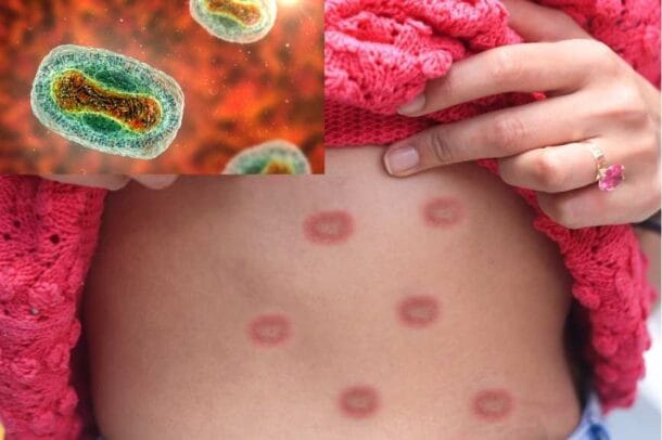 엠폭스 발생에서 예방