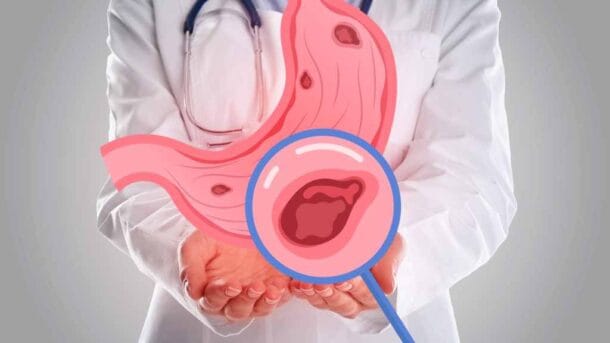 위염 위암 위장