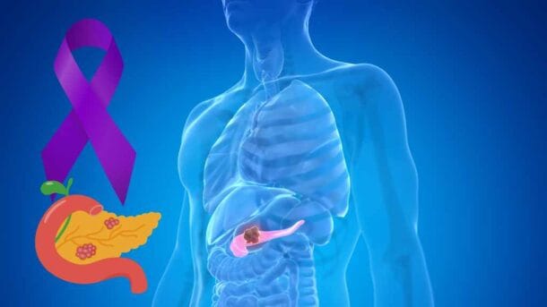 췌장암
