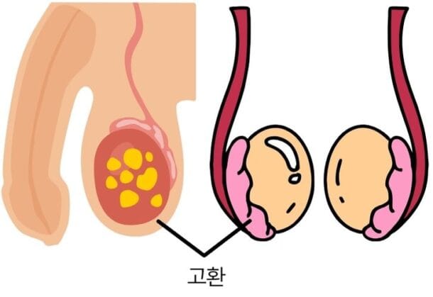 감기인 줄 알았는데 볼거리