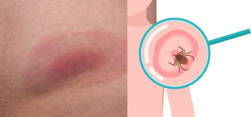 라임병 진드기