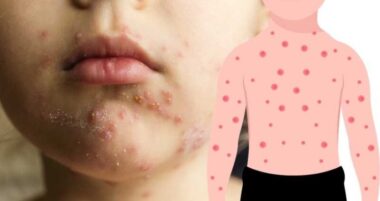 수두 앓았던 아이