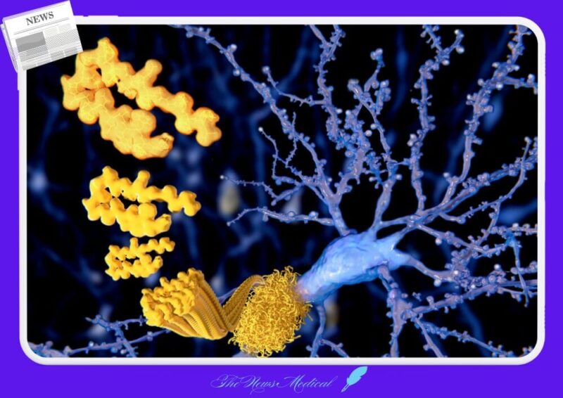 알츠하이머는 뇌 질환이 아니다