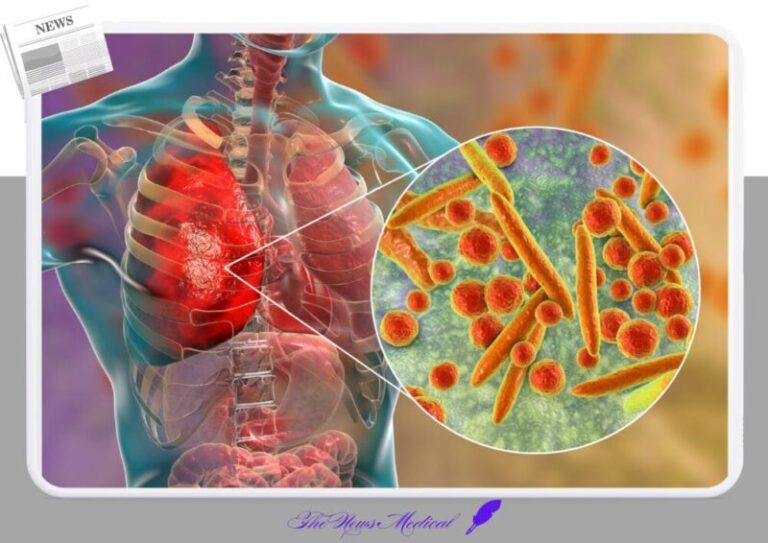폐렴 폐염증 세균 인체