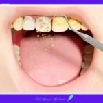 잇몸 치과 치아 치석 스케일링
