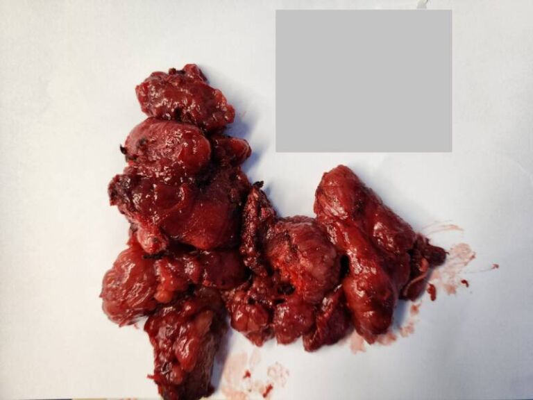 갑상선 고이터질환_20240828_191016285