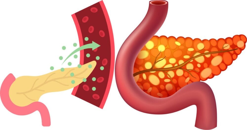 날씬한데 당뇨병