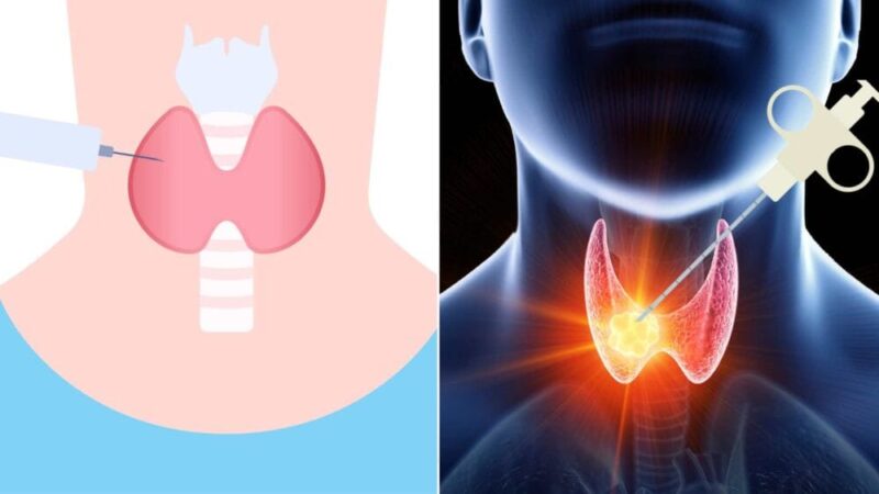 갑상선 세침검사