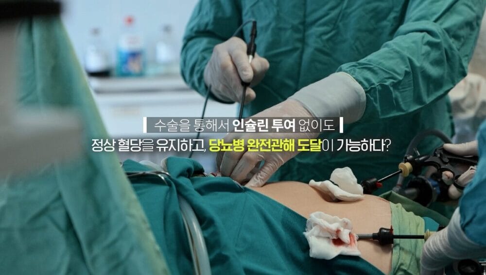 위소매절제술 당뇨