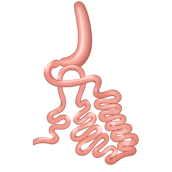 위소매회장우회술 비만대사수술 당뇨수술