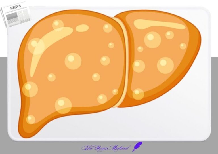 지방간 간장 간질환