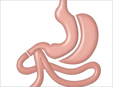 우리나라 최초 위소매 회장 우회술 시행