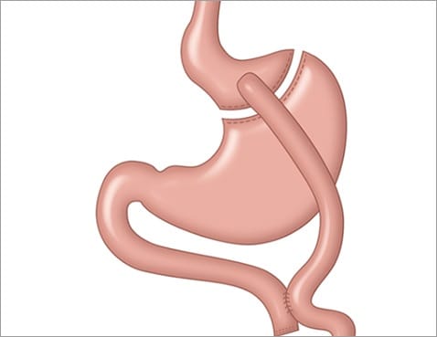 루와이 위 우회술 -1 비만대사수술 당뇨수술