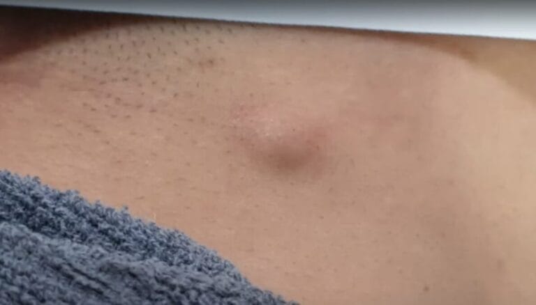 표피낭 종기 지방종 여드름