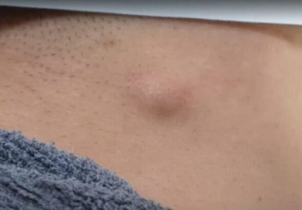 표피낭 종기 지방종 여드름