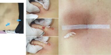 표피낭종 발생 부위