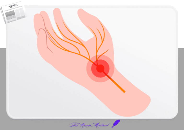방아쇠수지증후군 손가락 손신경