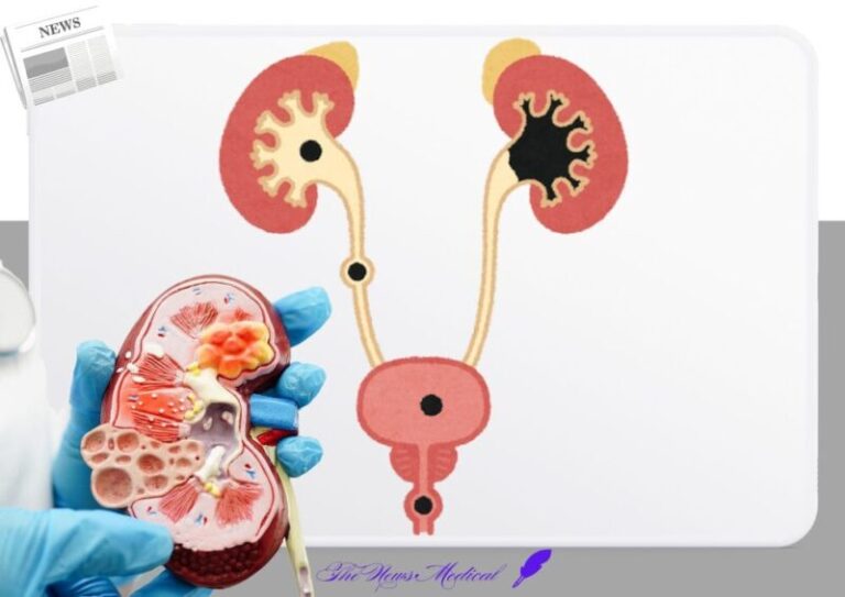 요로결석 신장 결석, 요관 결석, 방광 결석, 요도 결석