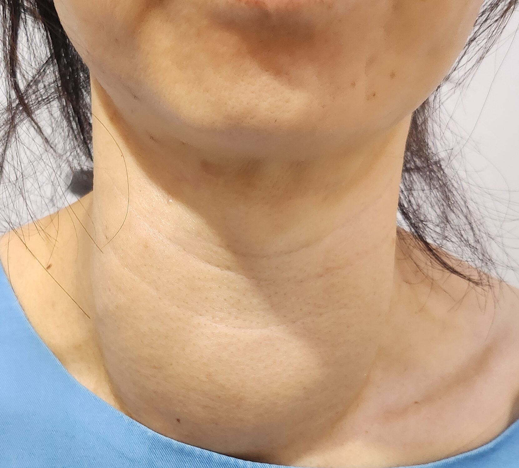 점점 커지는 갑상선