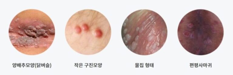 곤지름, 콘딜로마 비뇨,