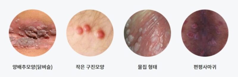 소리없이 찾아오는 성병 콘딜로마