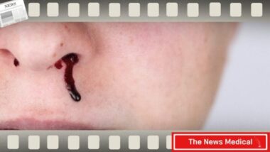 잘못된 코피 응급처치 상식