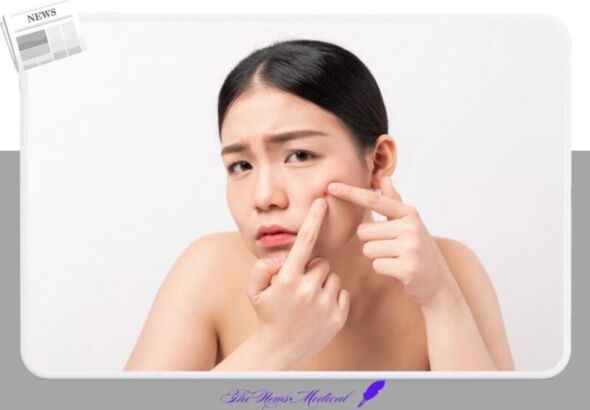 여드름 피부 청소년 청춘 짜다 짜내다