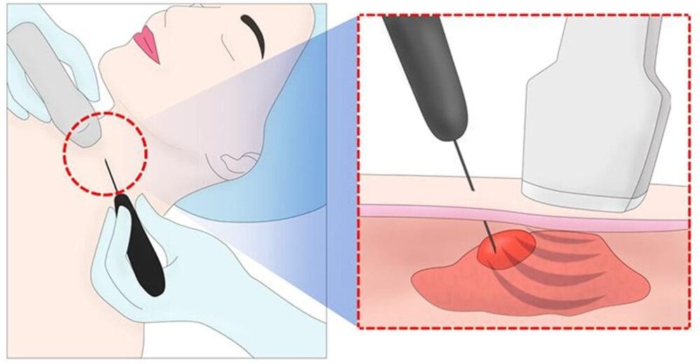 갑상선 종양 고주파 치료