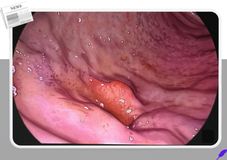 위선종(Gastric adenoma)