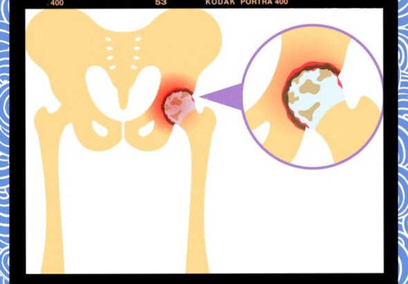 대퇴골절 골다공증