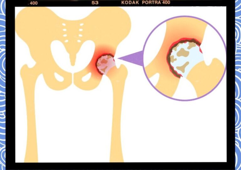 대퇴골절 골다공증