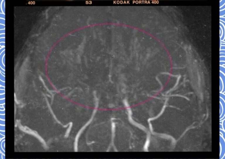 모야모야병 mra 뇌질환