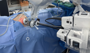 다빈치SP 로봇 수술