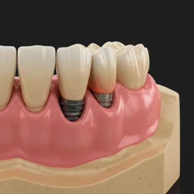 임플란트 수명 늘리는 법