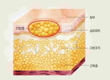 양성종양 _지방종_v1