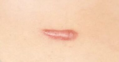 수술후 상처가 부풀어 오른다