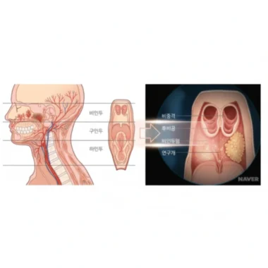 침묵의 경고 인두암