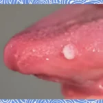 혀암, 설암,혓바닥(사진=더뉴스메디칼)
