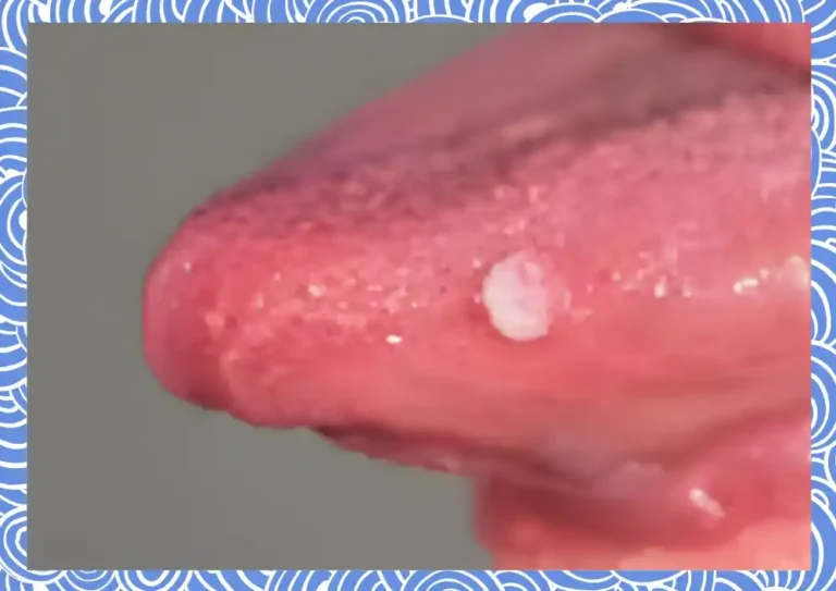 혀암, 설암,혓바닥(사진=더뉴스메디칼)