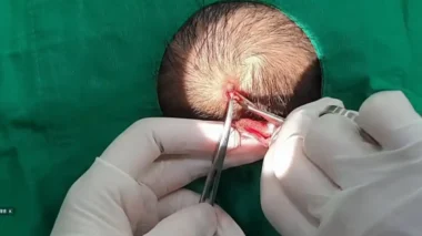 두피 표피낭 방치 시 영구적 탈모