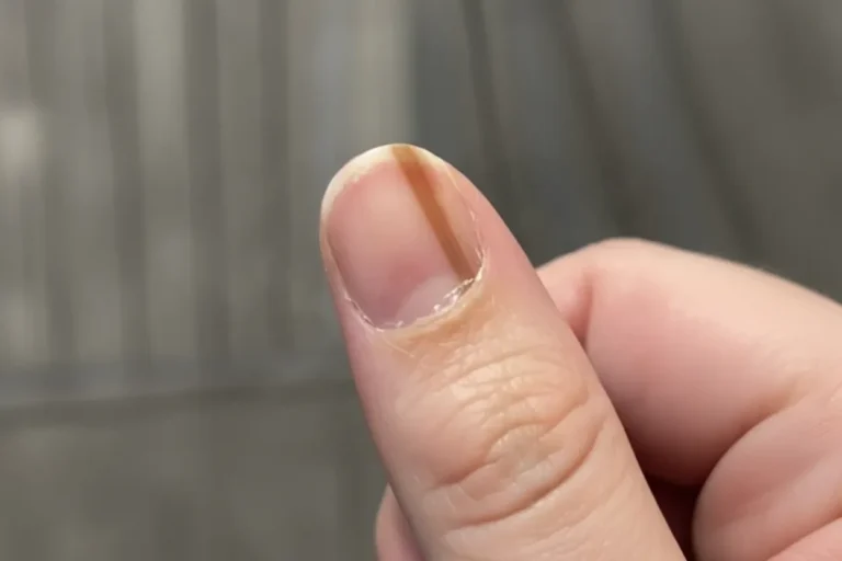 손톱 검은세로줄 흑색종_resized