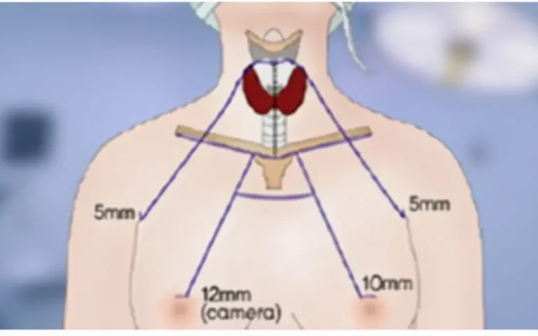 갑상선암 내시경수술 baba(사진=더뉴스메디칼)