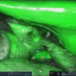 다빈치 ICG 그린 형광카메라 담낭수술_resized