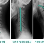 거북목, 일자목, 목통증(사진=더뉴스메디칼)
