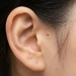 전이개누공-이개전이공-귓구멍_resized_resized